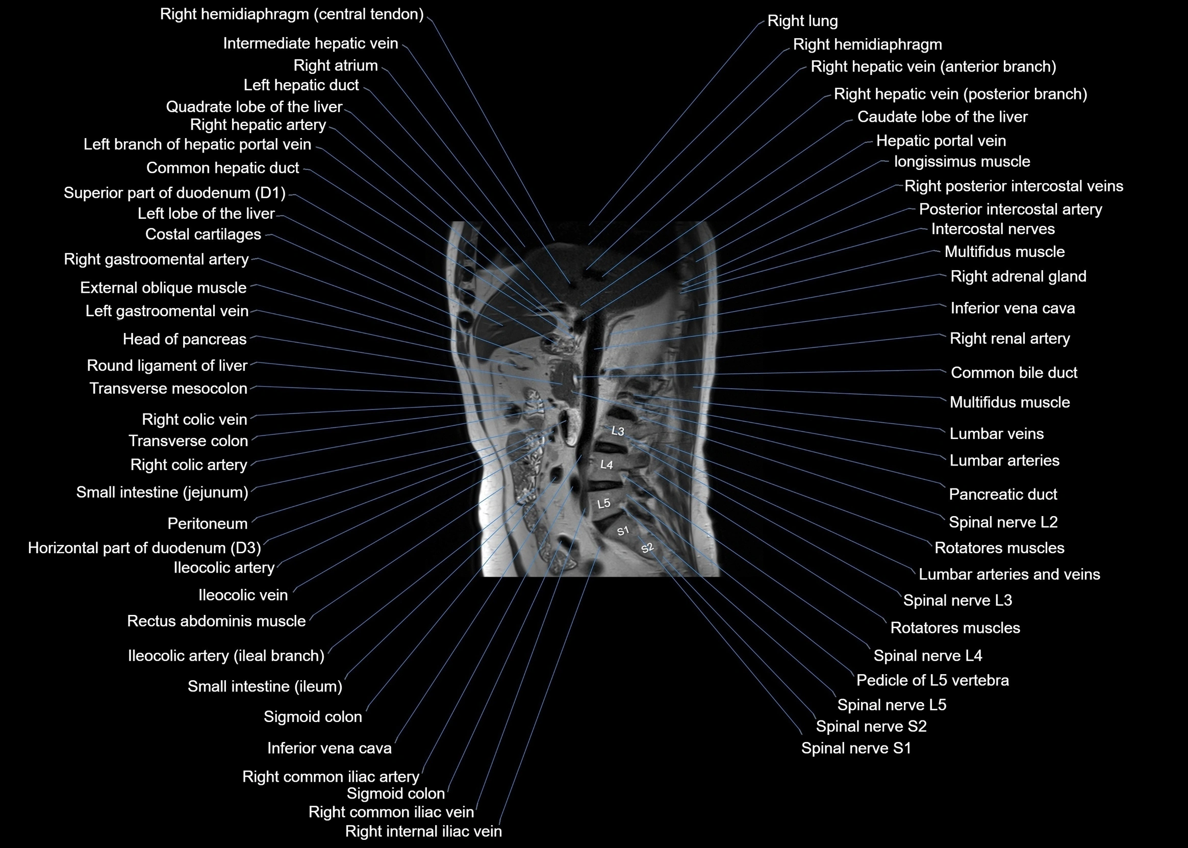 MRI abdomen sagittal cross sectional anatomy  radiology  image-img-00001-00032.webp